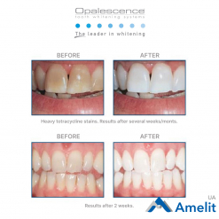 Відбілююча система Opalescence 16%PF (Ultradent), шприц 1.2 мл